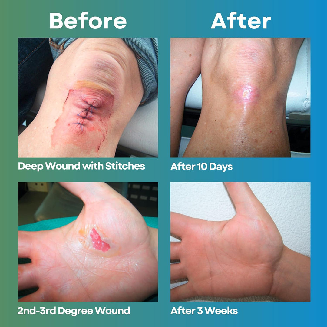 MediQuick Skin & Wound Repair (4oz) aids in healing skin conditions like Acne, Cuts, Burns, Eczema, Rashes & Sunburns. A 12-hour, one-step solution, it cleans skin, removes bacteria. All-natural, sting-free formula suitable for Adults, Kids & Pets.